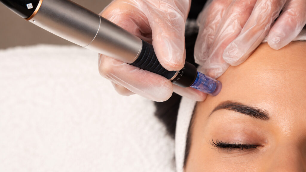 Microneedling Behandlung